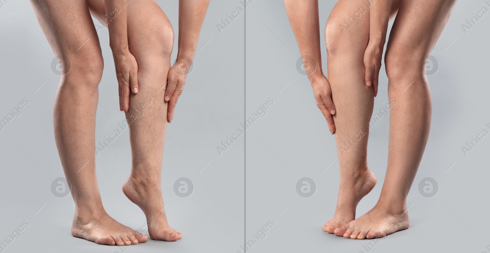 Image of Varicose veins treatment. Woman showing legs on grey background, closeup. Before and after collage