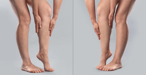 Image of Varicose veins treatment. Woman showing legs on grey background, closeup. Before and after collage