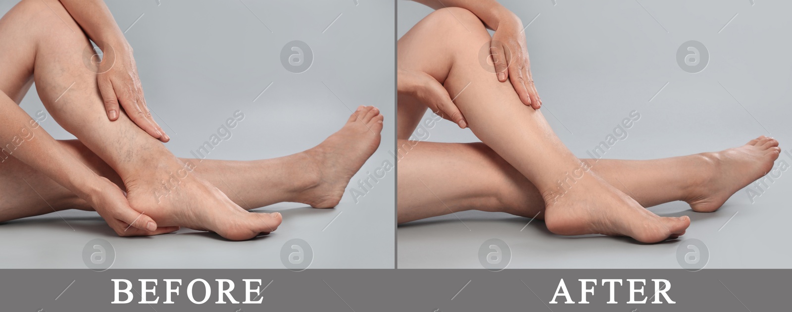 Image of Varicose veins treatment. Woman showing legs on grey background, closeup. Before and after collage