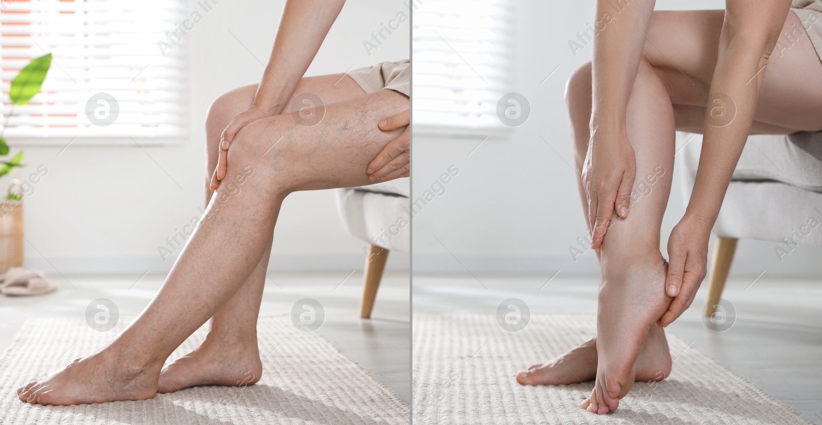 Image of Varicose veins treatment. Woman showing legs at home, closeup. Before and after collage