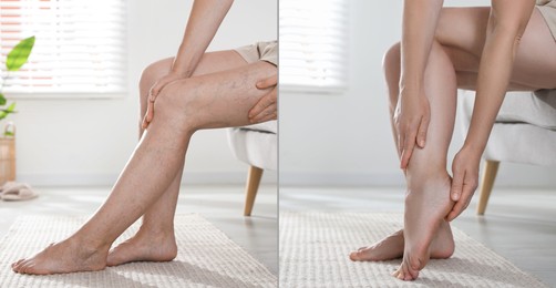 Image of Varicose veins treatment. Woman showing legs at home, closeup. Before and after collage