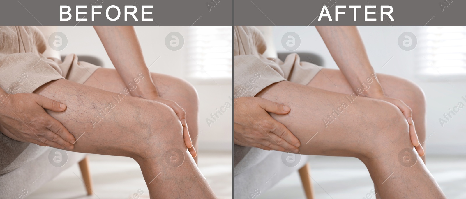 Image of Varicose veins treatment. Woman showing legs at home, closeup. Before and after collage