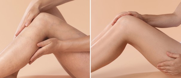 Varicose veins treatment. Woman showing legs on dark beige background, closeup. Before and after collage