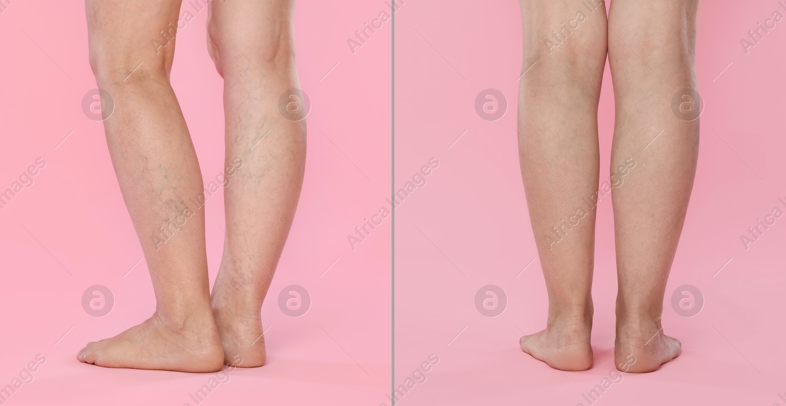 Image of Varicose veins treatment. Woman showing legs on pink background, closeup. Before and after collage