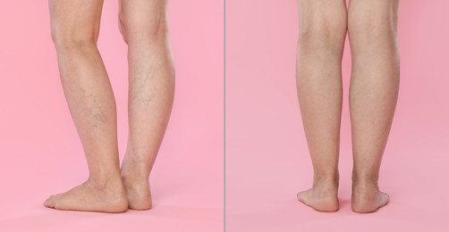 Image of Varicose veins treatment. Woman showing legs on pink background, closeup. Before and after collage