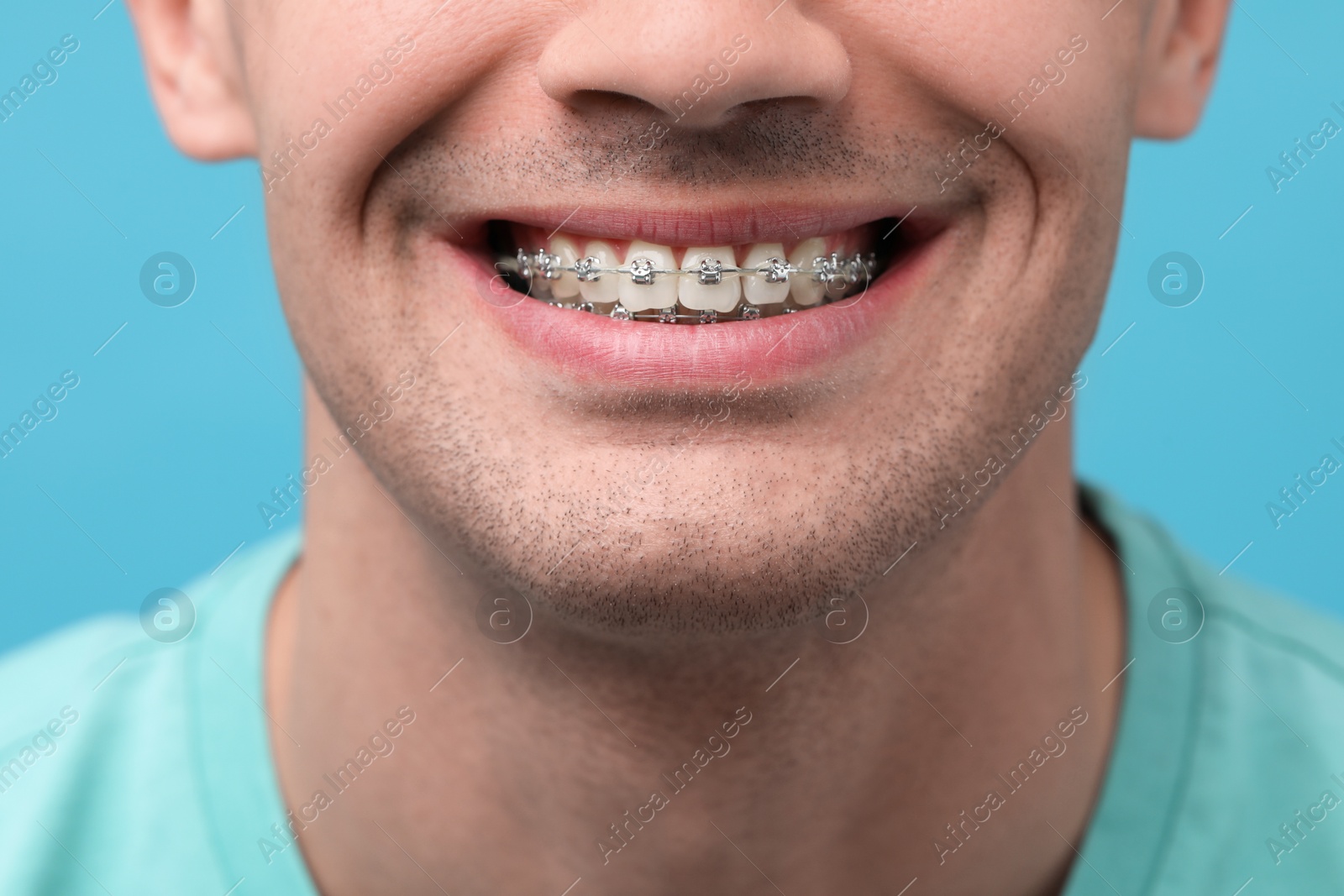 Photo of Smiling man with dental braces on light blue background, closeup