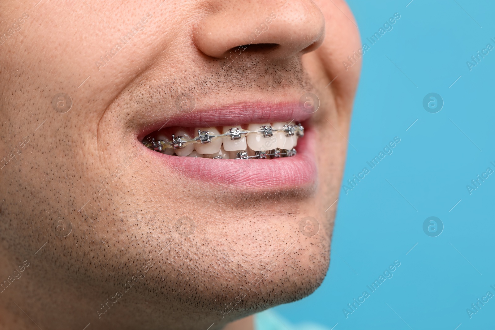 Photo of Smiling man with dental braces on light blue background, closeup