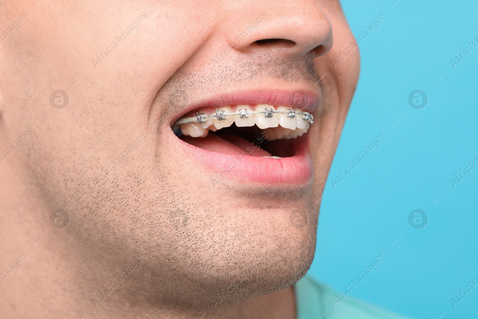 Photo of Man with dental braces on light blue background, closeup