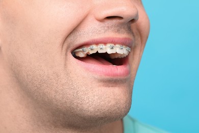 Man with dental braces on light blue background, closeup