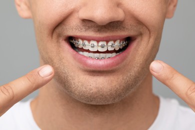 Photo of Smiling man pointing at his dental braces on grey background, closeup