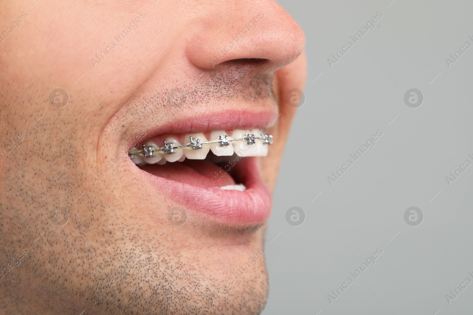 Photo of Happy man with dental braces on grey background, closeup. Space for text