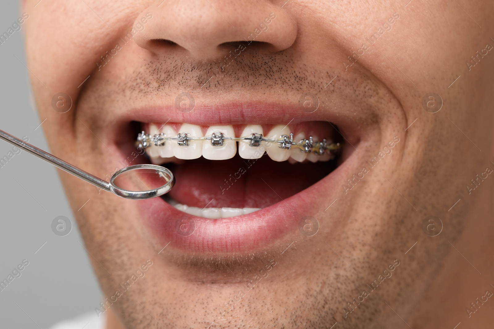 Photo of Examination of man's teeth with braces using mirror tool on grey background, closeup