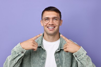 Happy man pointing at his dental braces on violet background