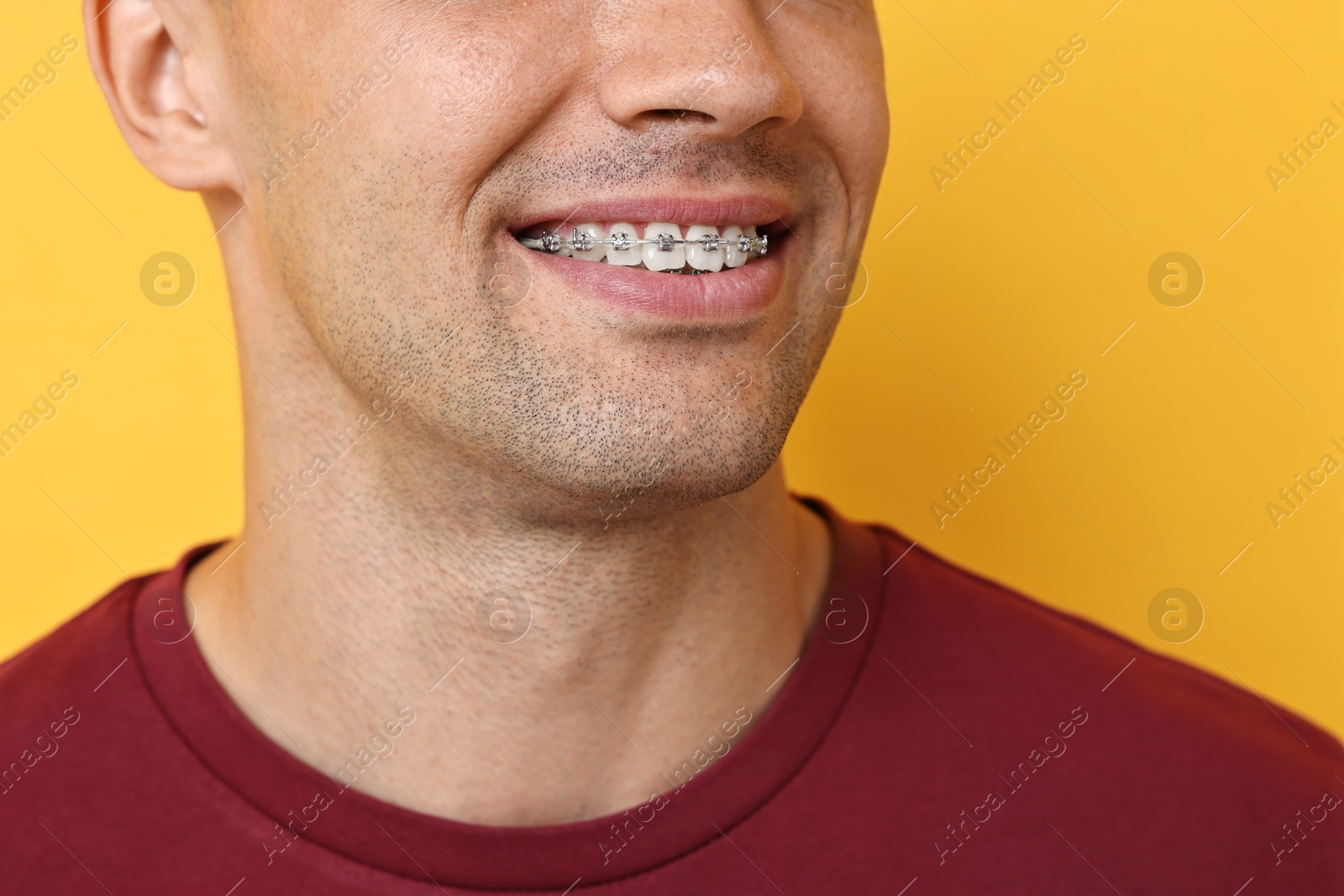 Photo of Smiling man with dental braces on yellow background, closeup