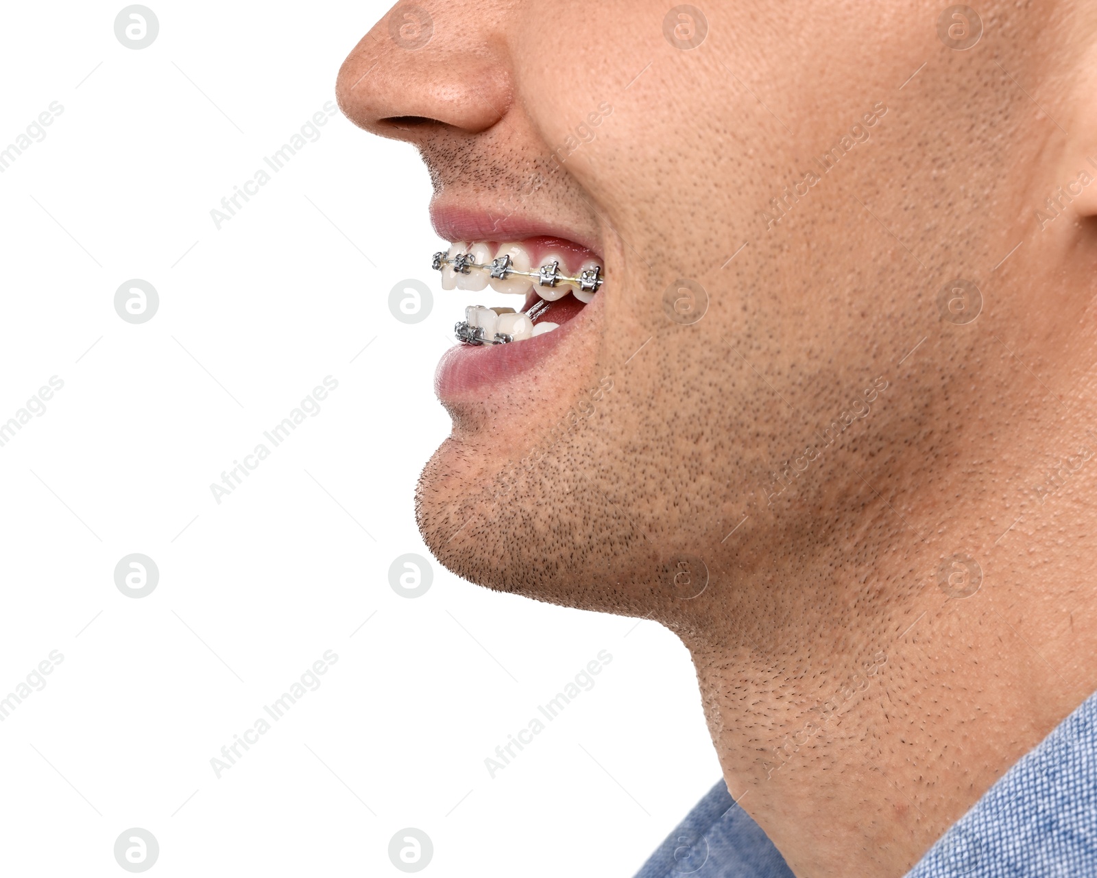 Photo of Happy man with dental braces on white background, closeup