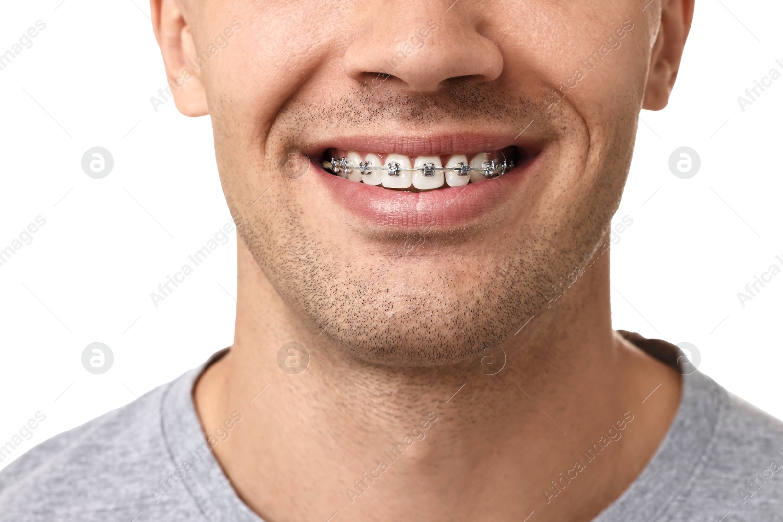 Photo of Smiling man with dental braces on white background, closeup