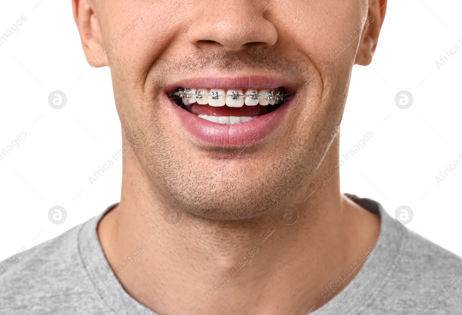 Photo of Smiling man with dental braces on white background, closeup