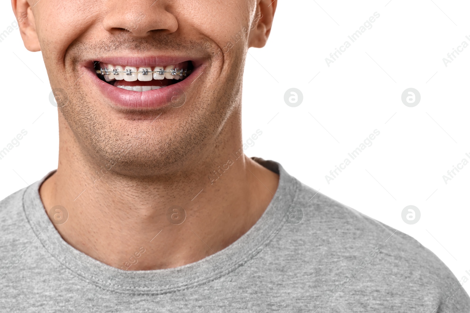 Photo of Smiling man with dental braces on white background, closeup