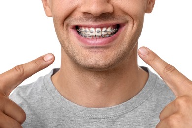 Photo of Smiling man pointing at his dental braces on white background, closeup