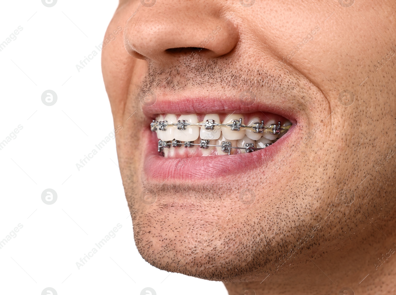 Photo of Smiling man with dental braces on white background, closeup