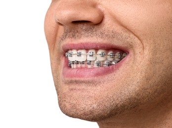 Smiling man with dental braces on white background, closeup