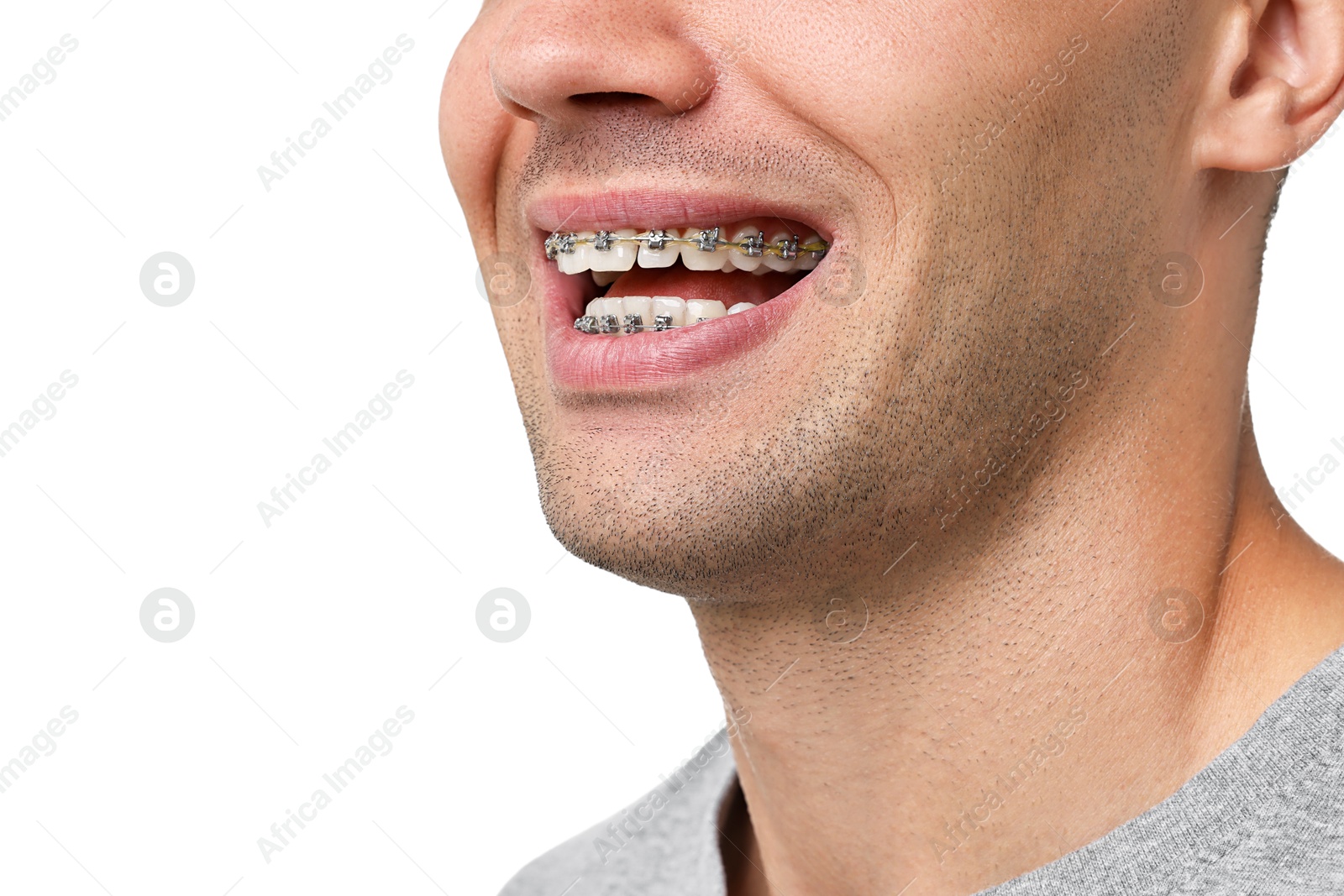 Photo of Happy man with dental braces on white background, closeup