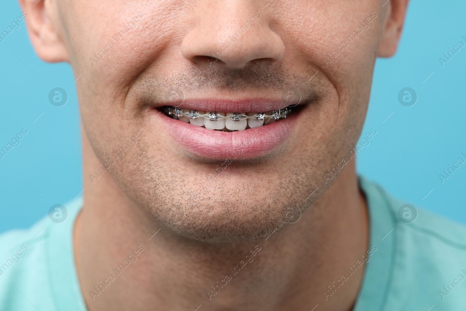 Photo of Smiling man with dental braces on light blue background, closeup