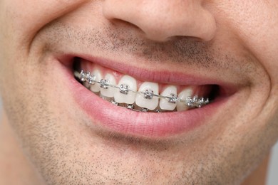 Smiling man with dental braces, closeup view