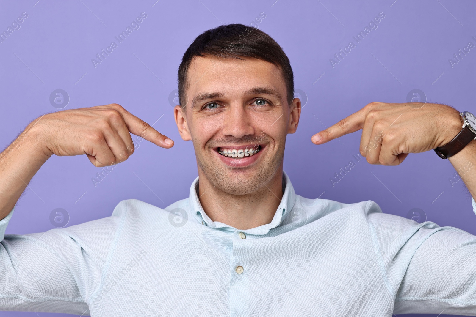 Photo of Happy man pointing at his dental braces on violet background