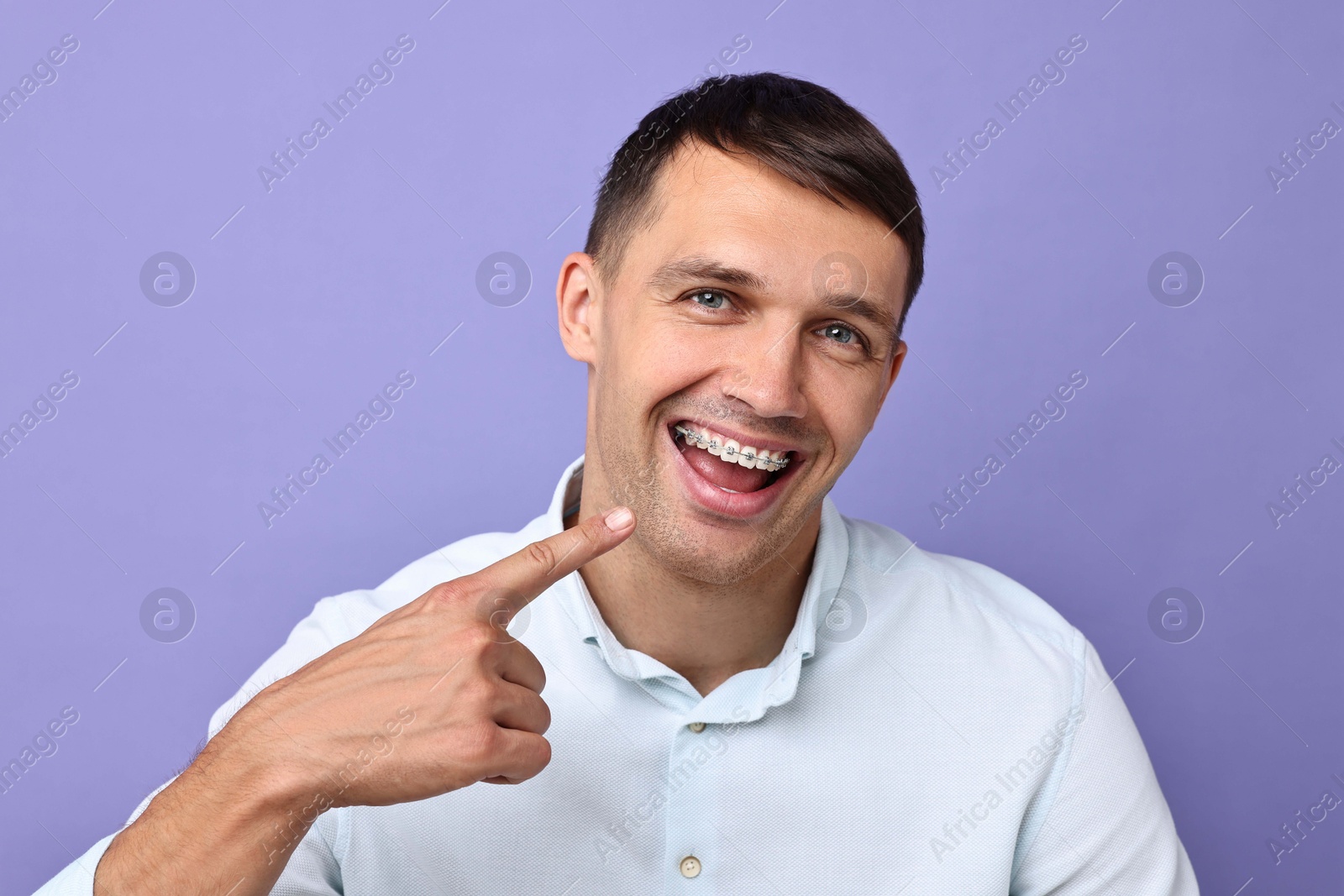 Photo of Happy man pointing at his dental braces on violet background