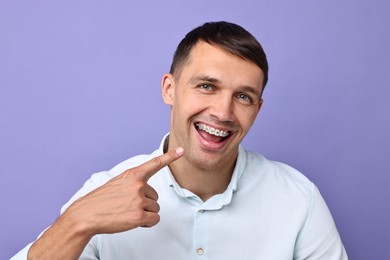 Happy man pointing at his dental braces on violet background