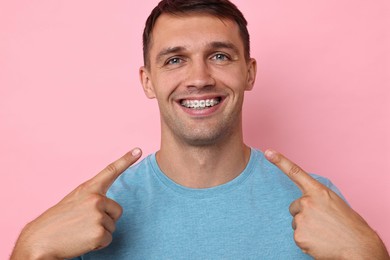 Happy man pointing at his dental braces on pink background