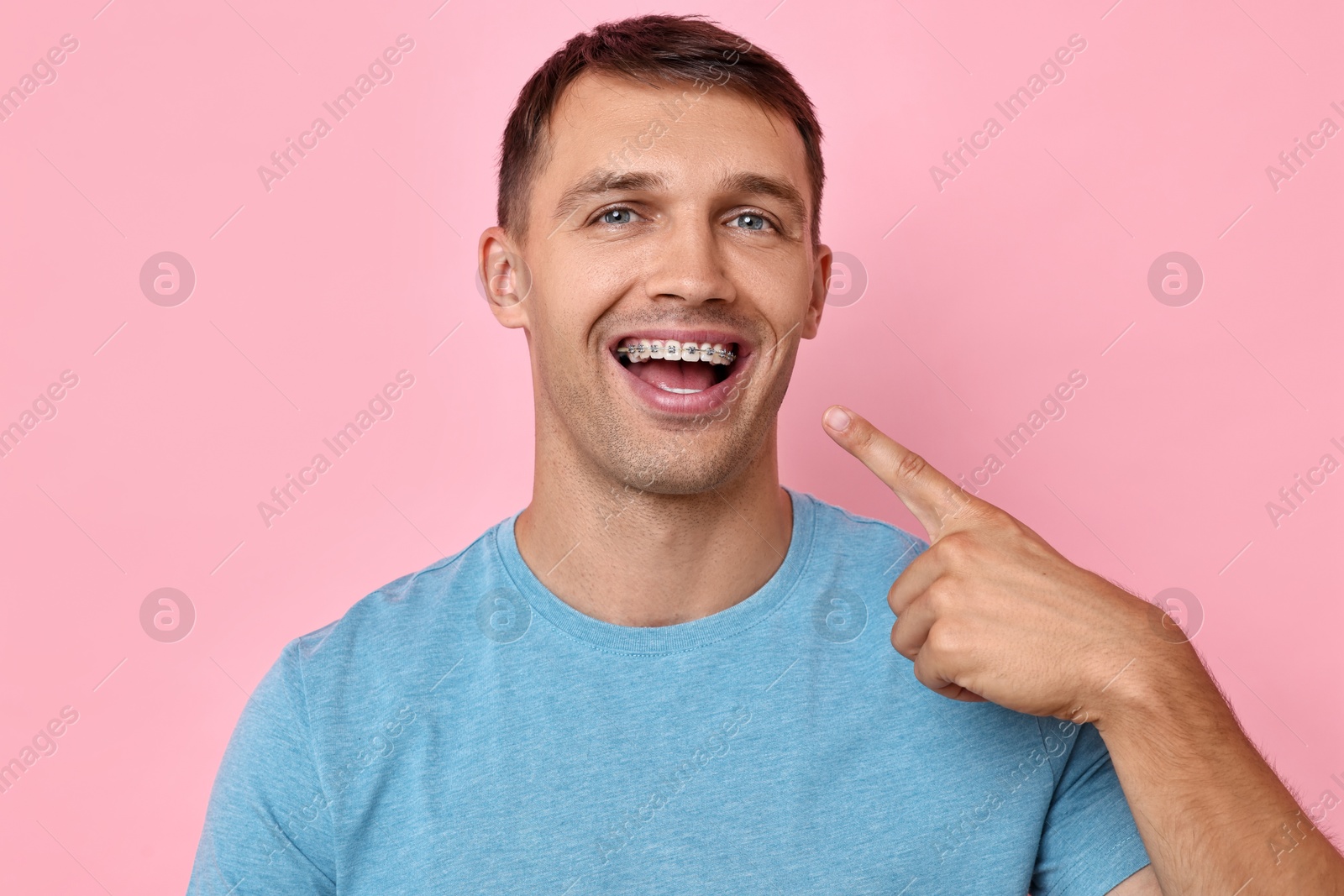 Photo of Happy man pointing at his dental braces on pink background