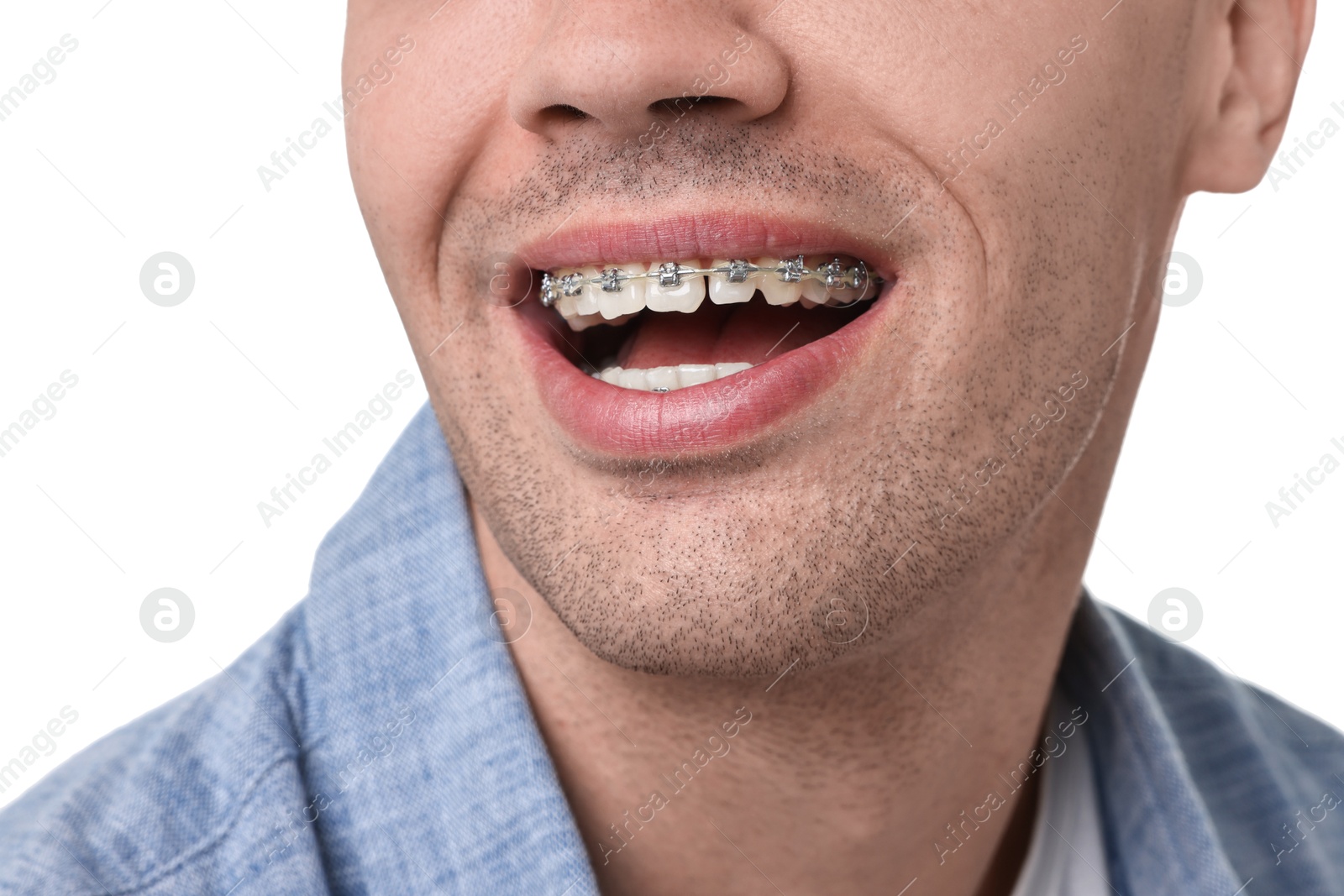 Photo of Happy man with dental braces on white background, closeup