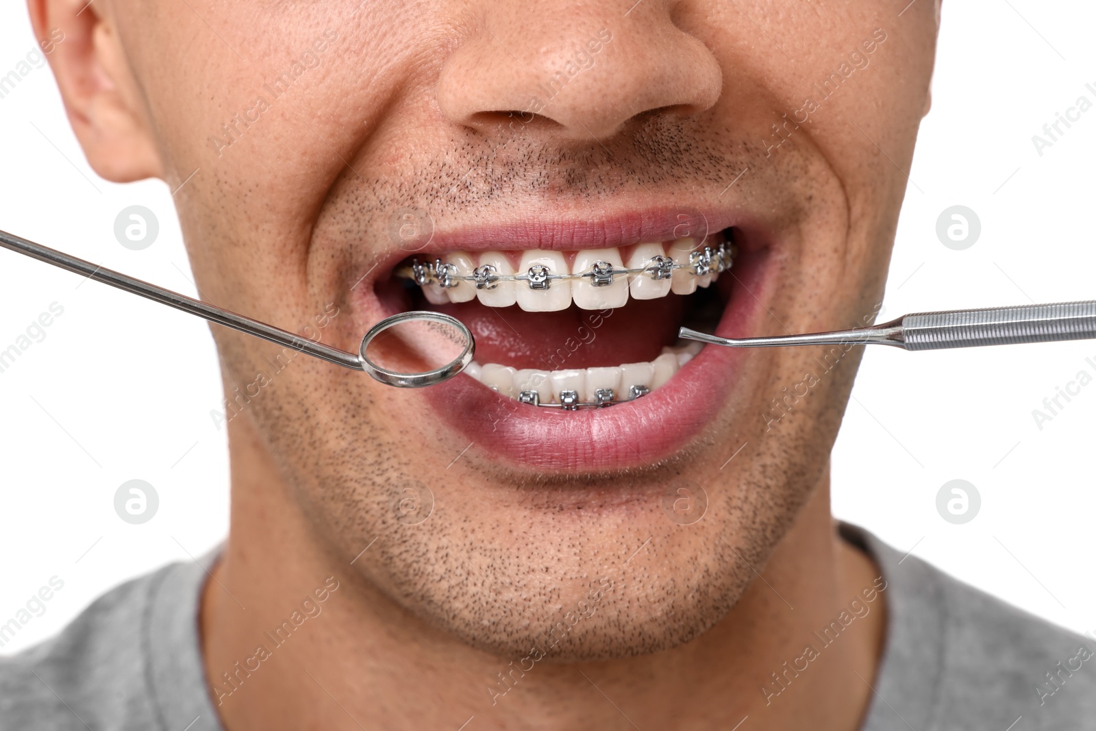 Photo of Examination of man's teeth with braces using dental tools on white background, closeup