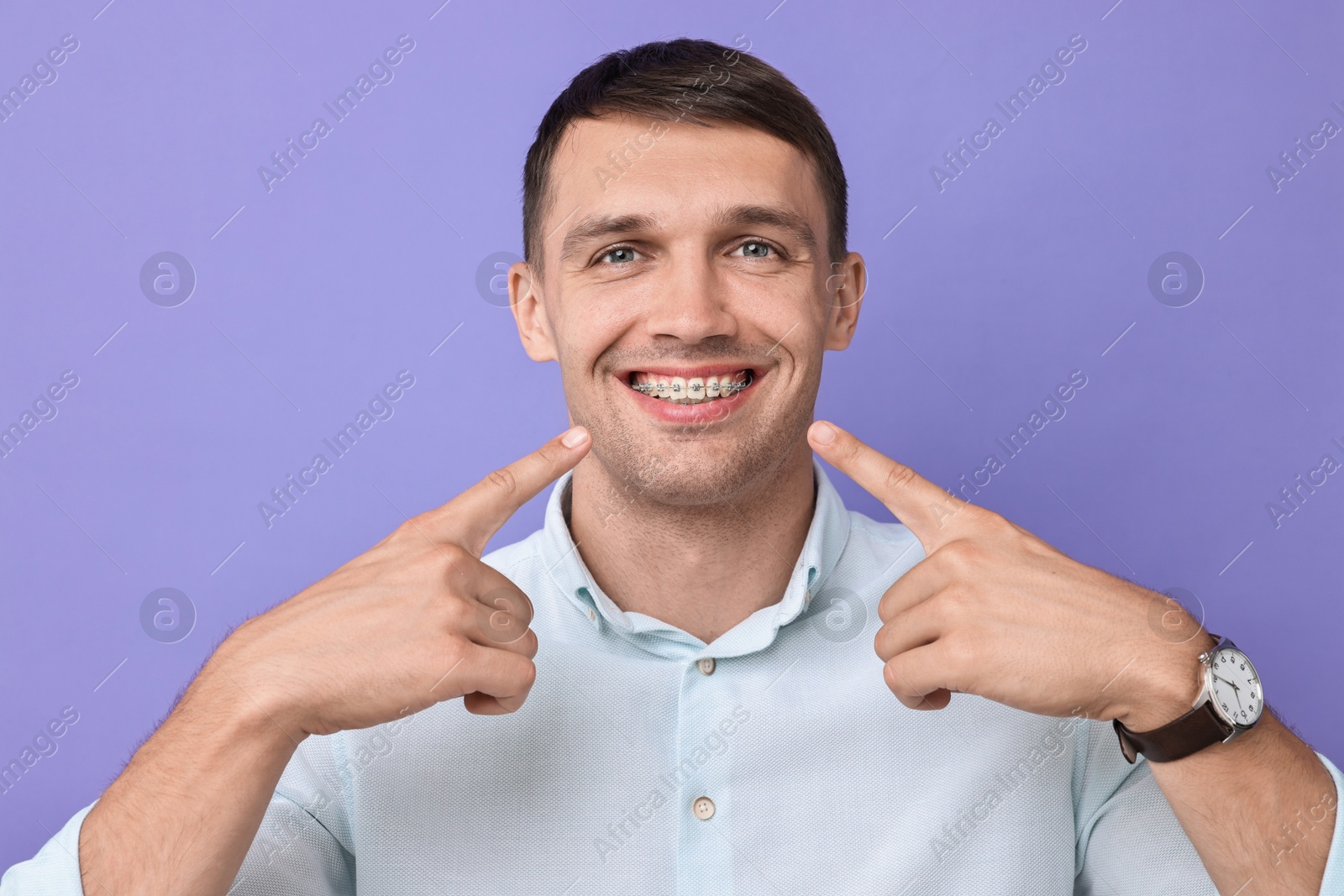 Photo of Happy man pointing at his dental braces on violet background