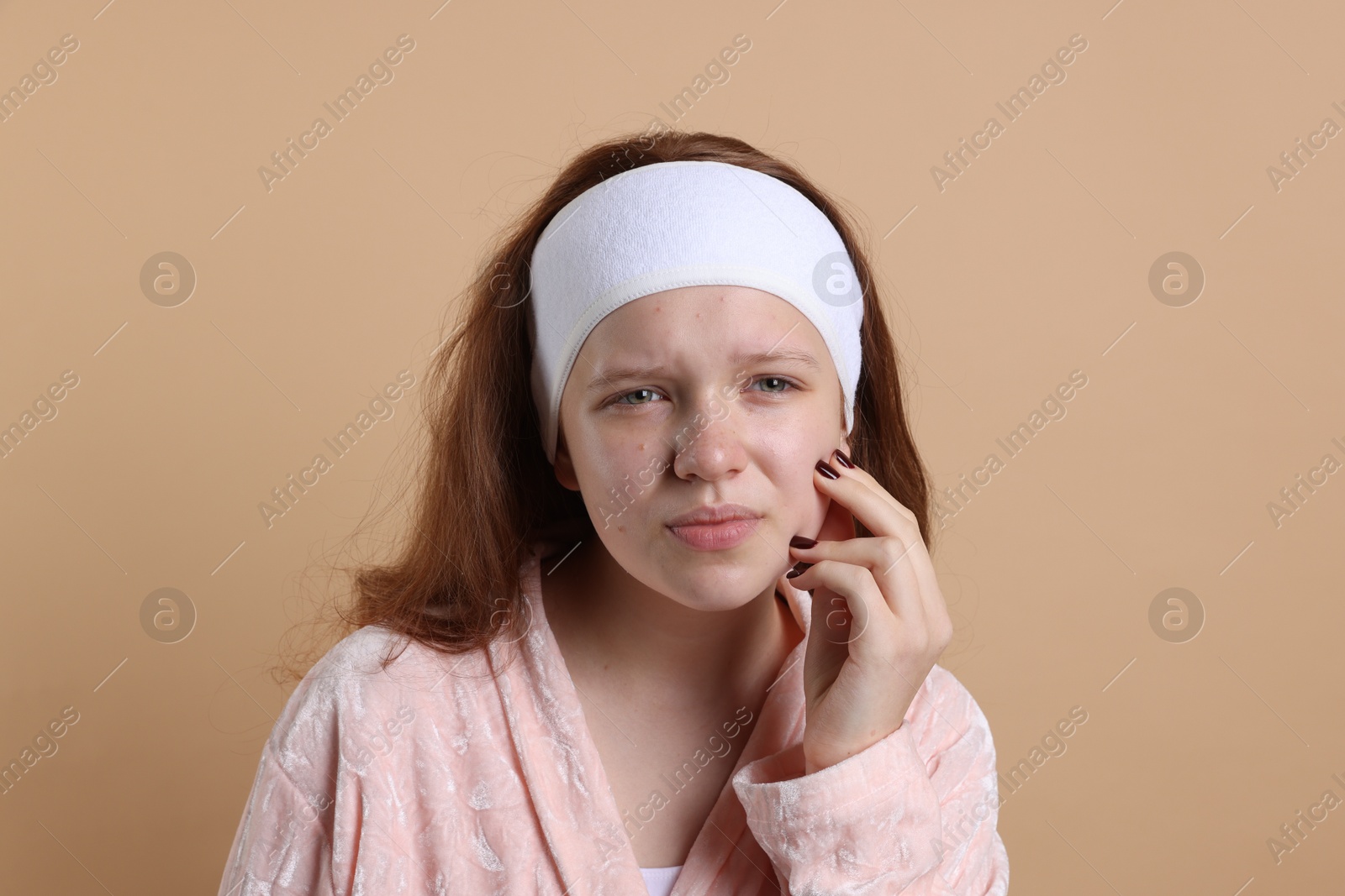 Photo of Teenage girl suffering from acne against beige background