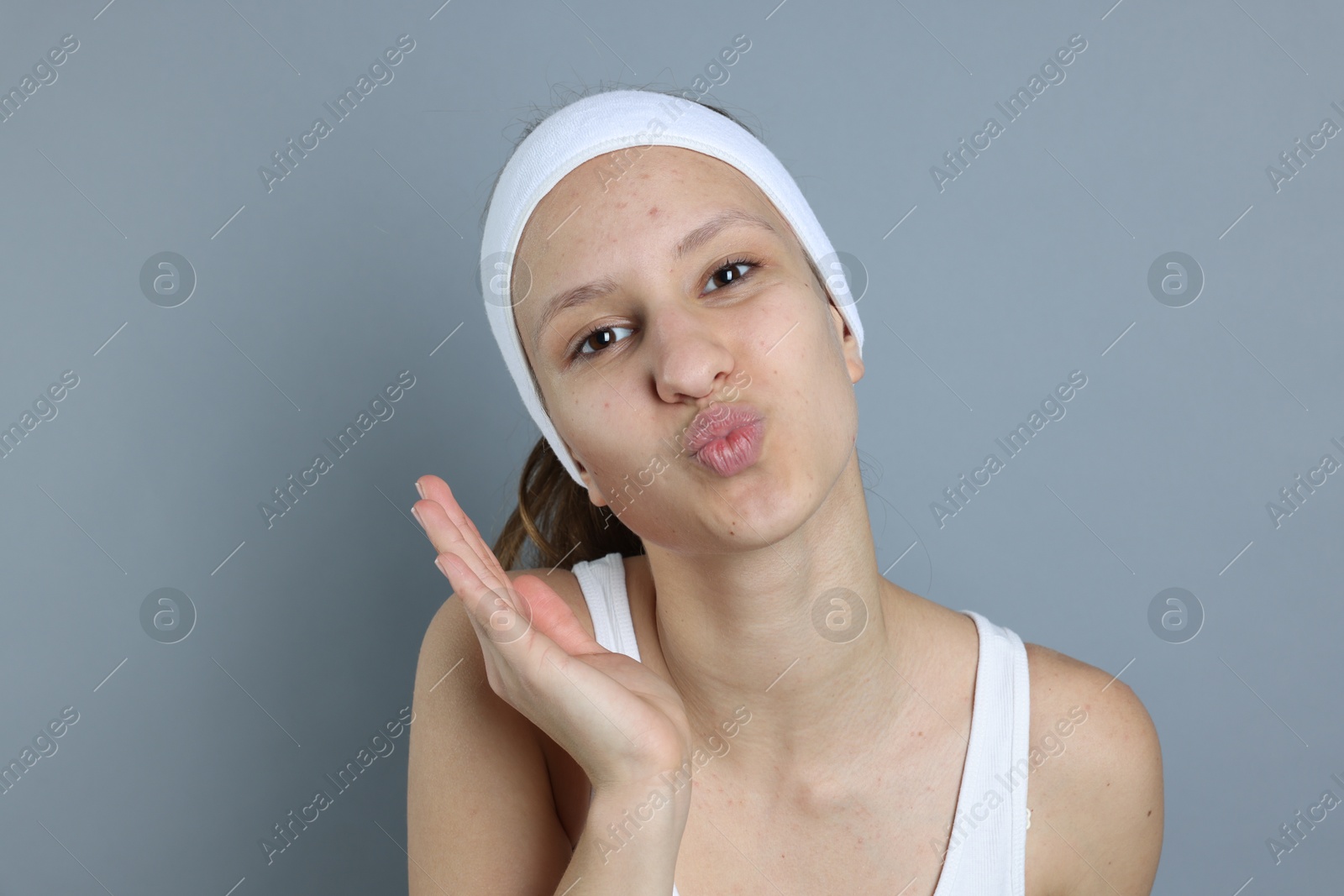 Photo of Teenage girl with acne problem on grey background