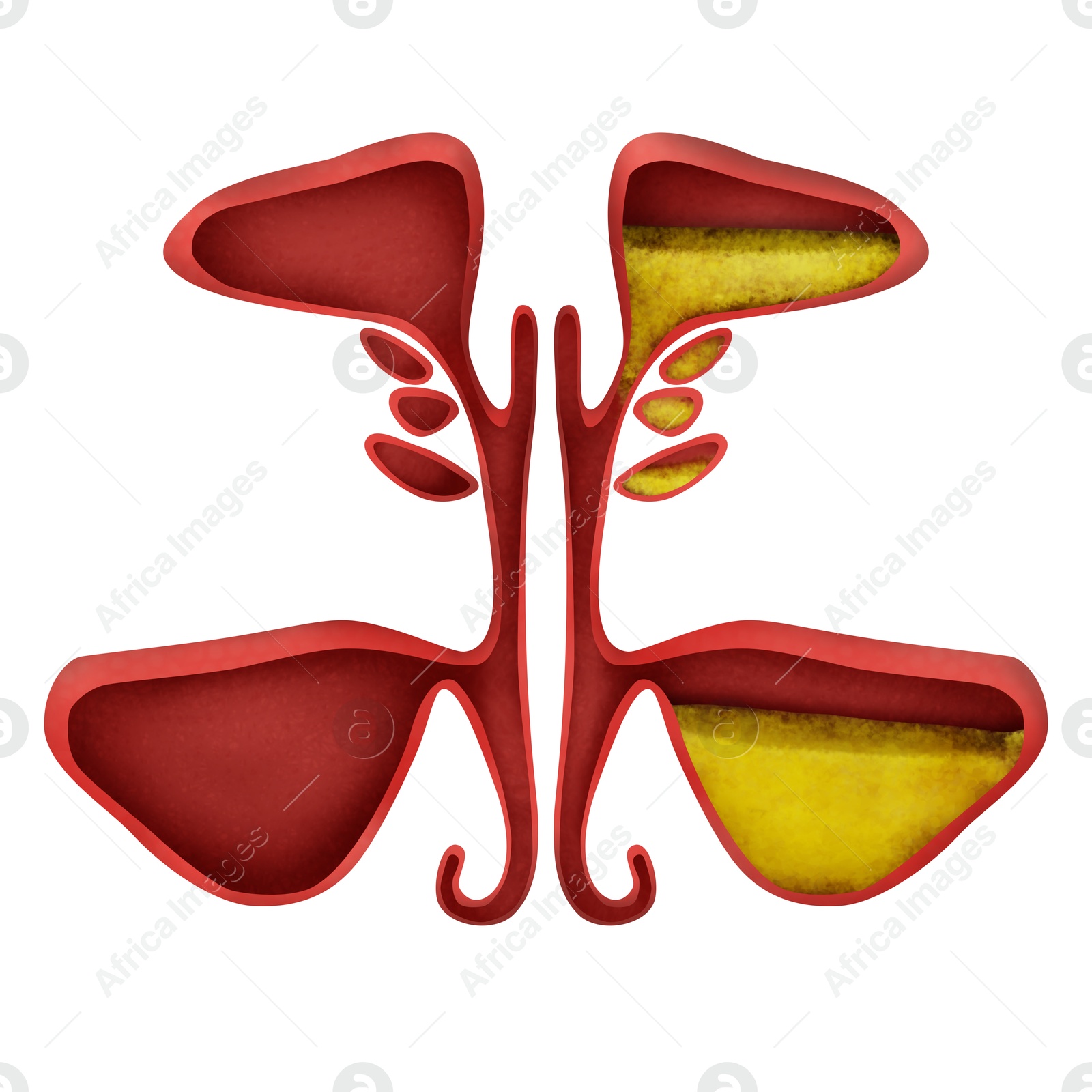 Image of Healthy and diseased sinuses, illustration on white background