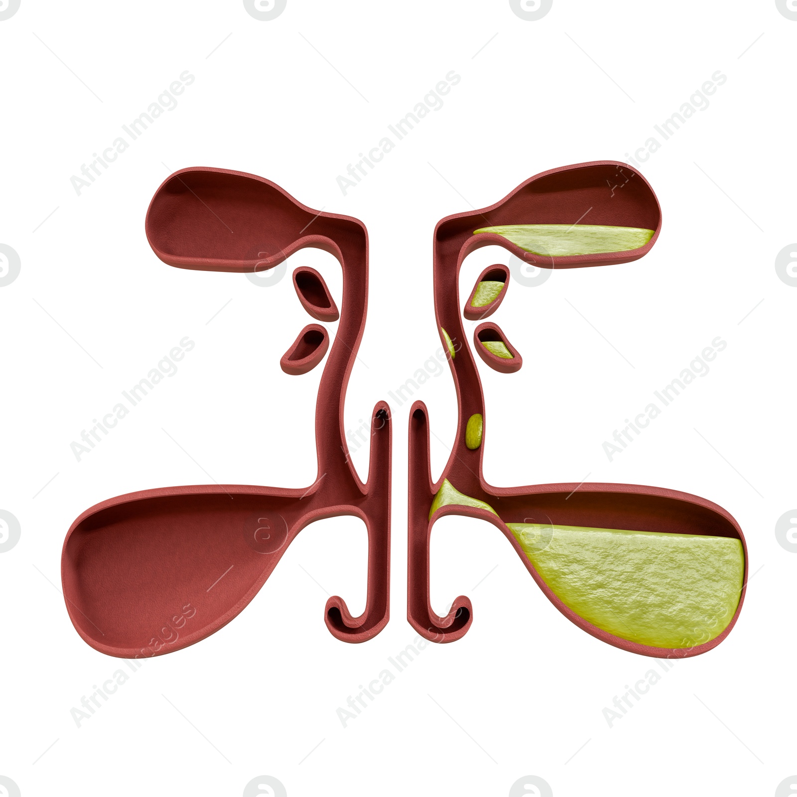 Image of Healthy and diseased sinuses, illustration on white background