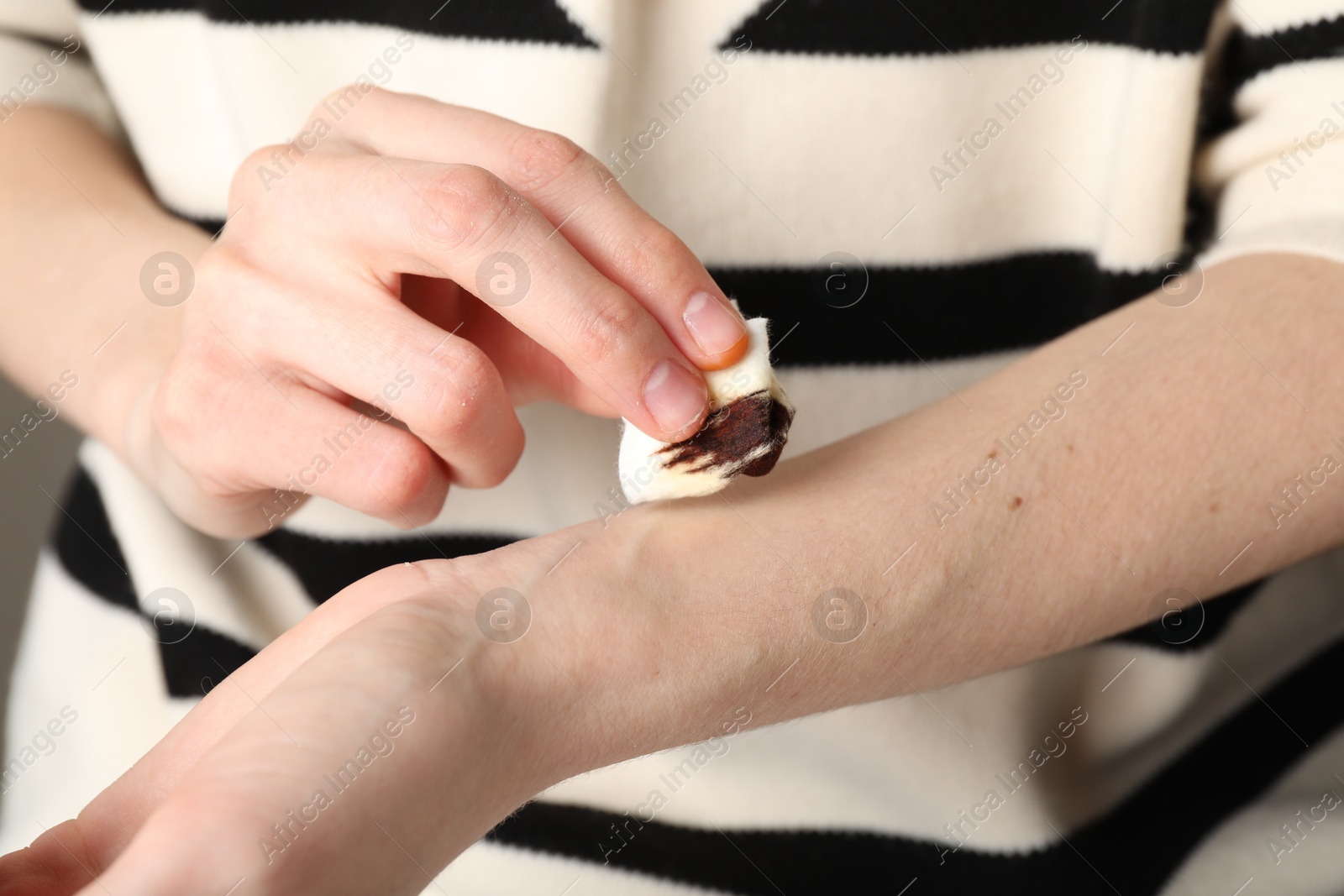 Photo of Woman applying topical iodine with cotton pad on hand, closeup