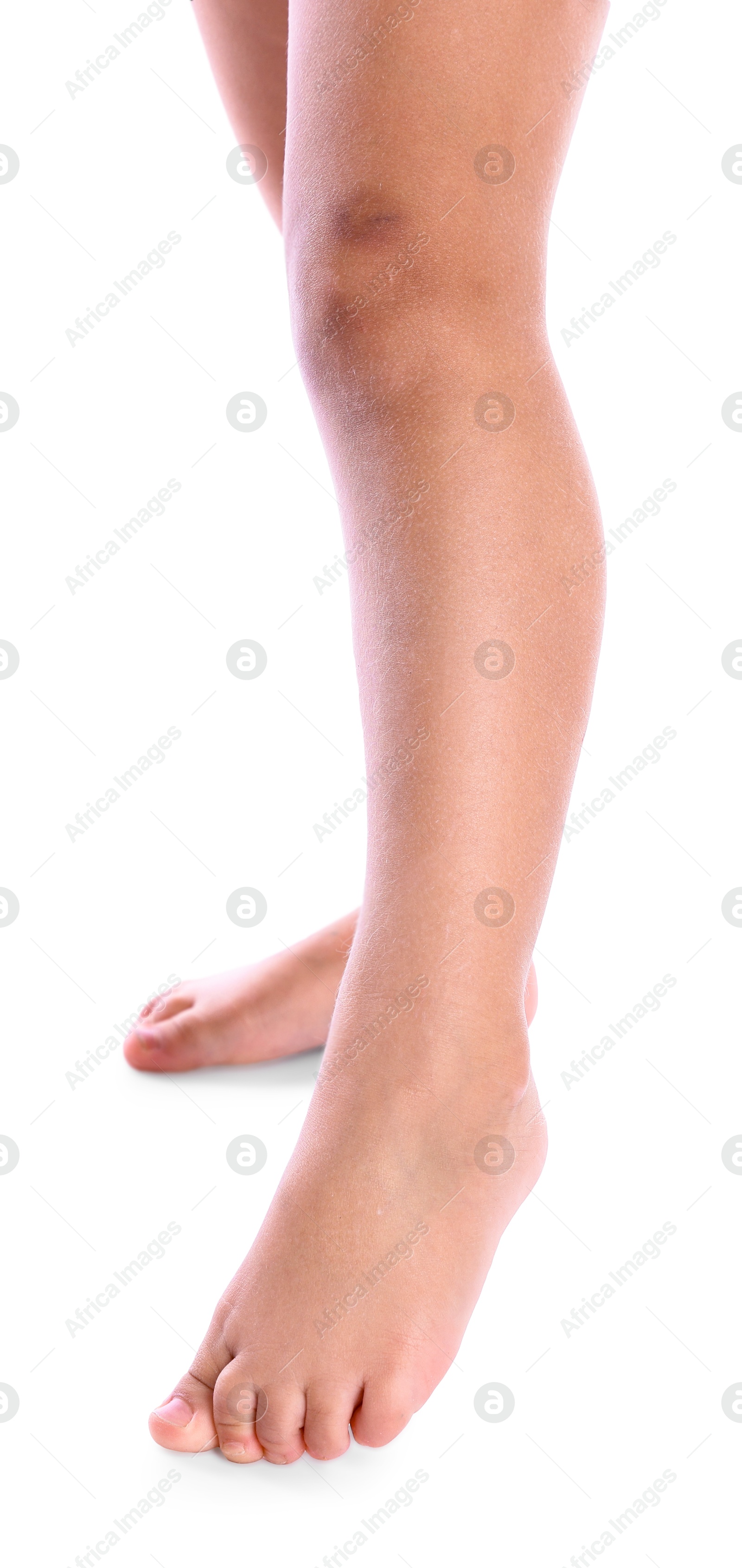 Photo of Child with bruise on leg against white background, closeup