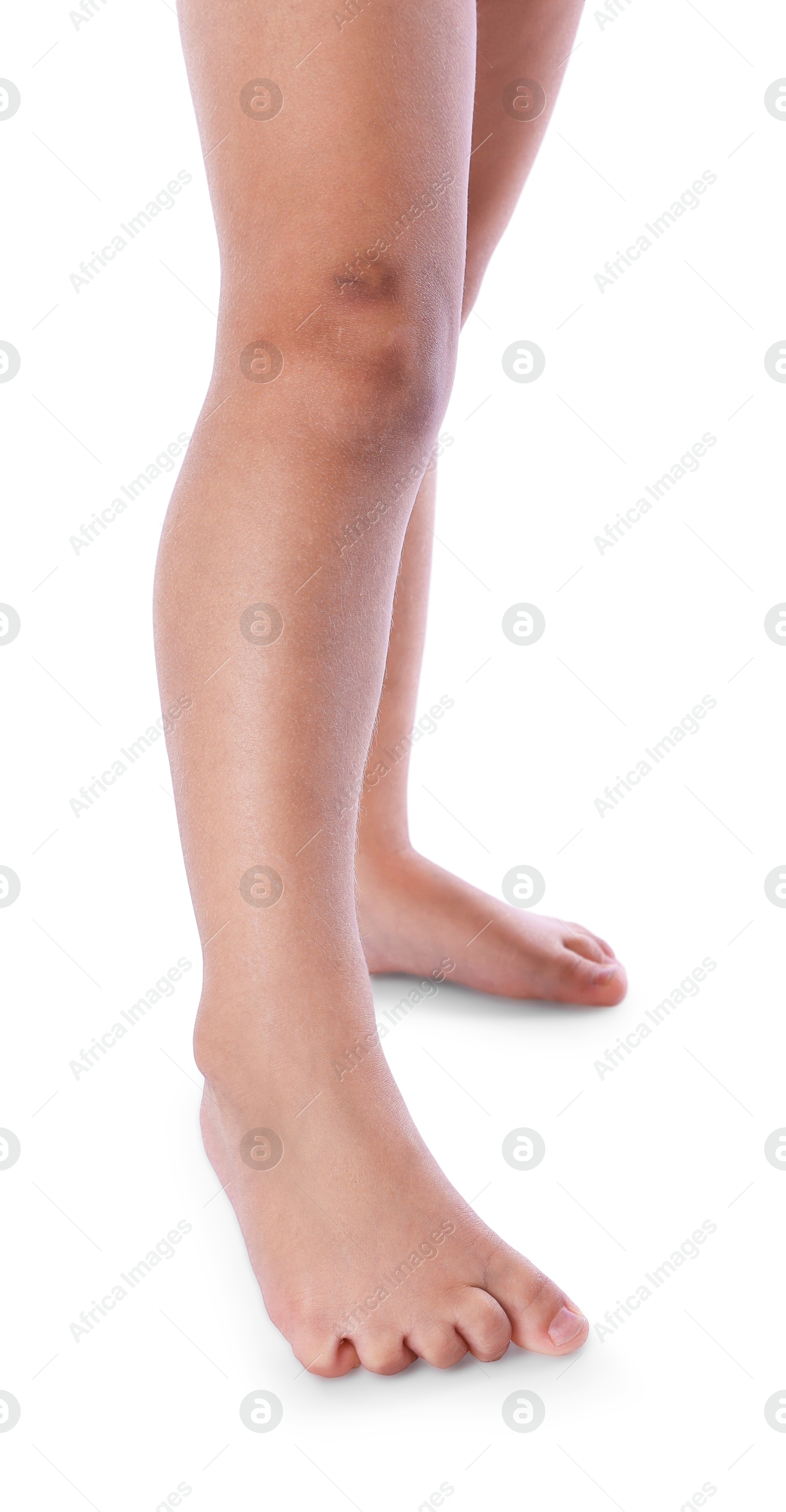 Photo of Child with bruise on leg against white background, closeup