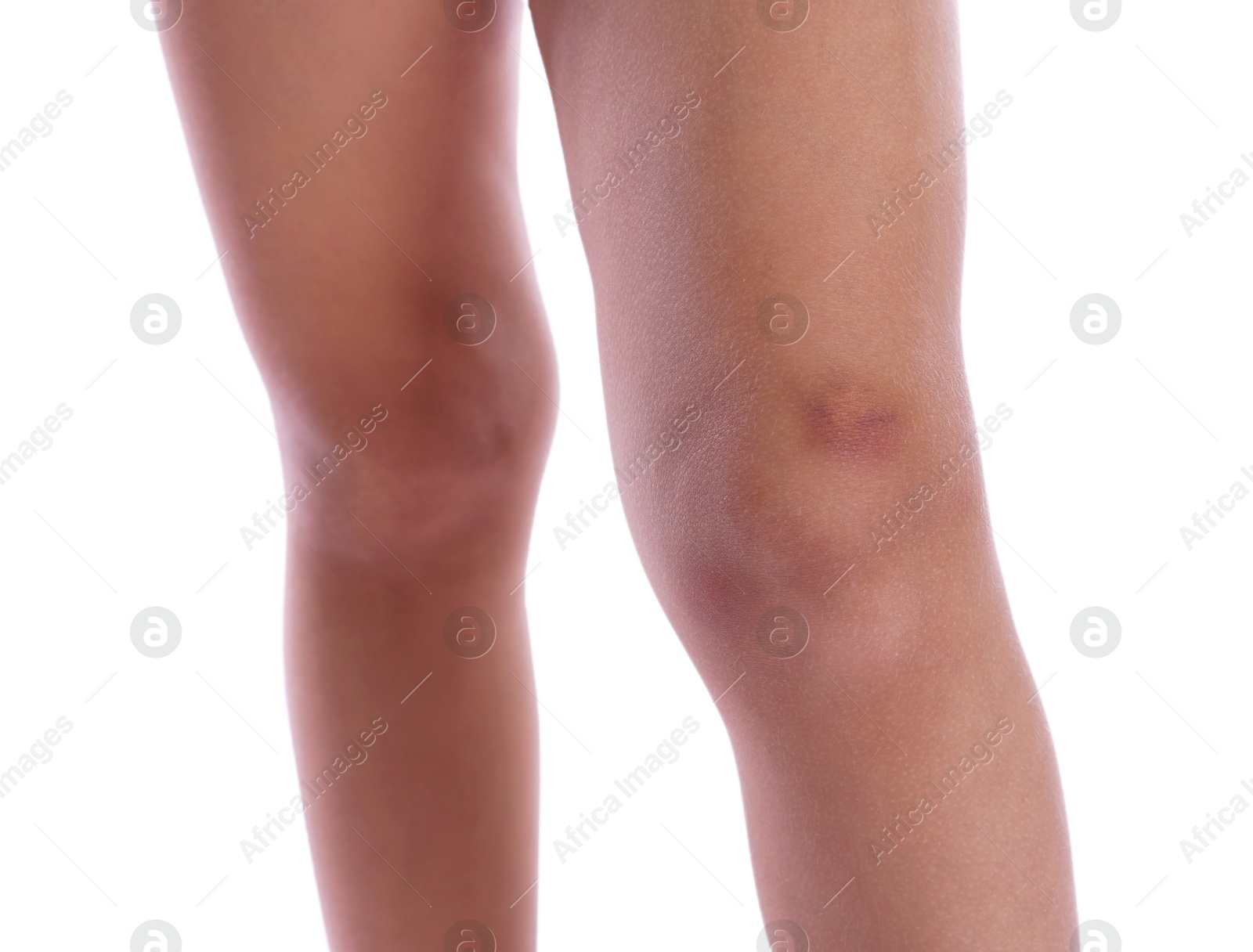 Photo of Child with bruise on leg against white background, closeup