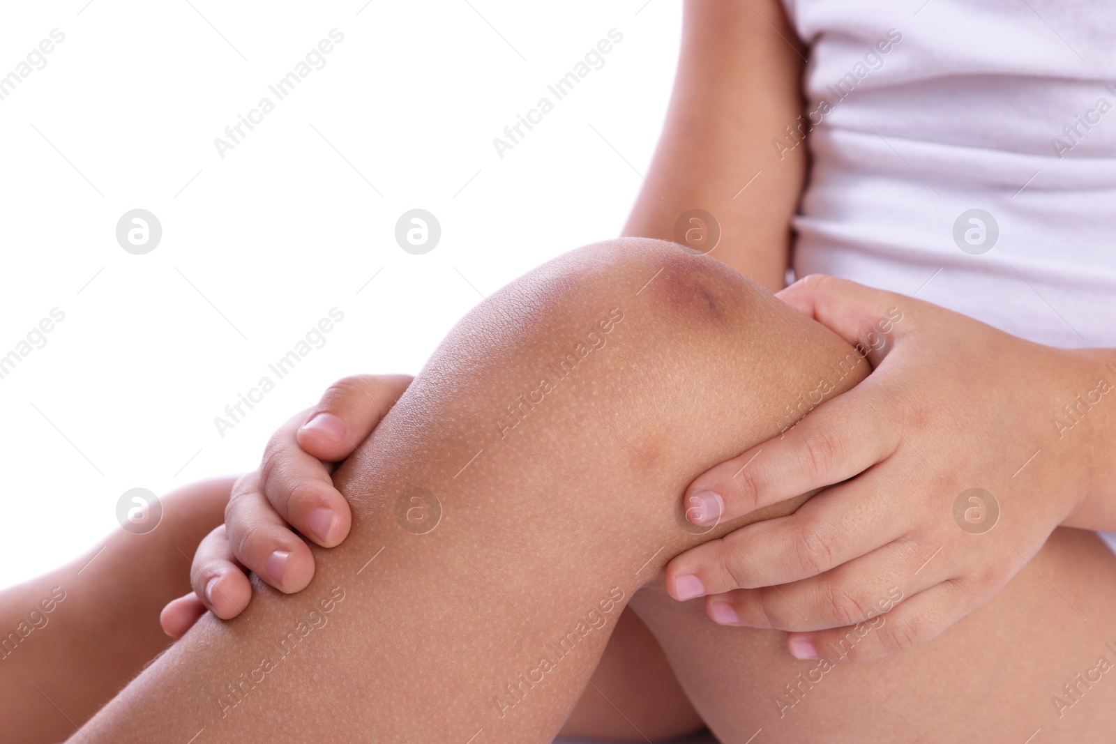 Photo of Child with bruise on leg against white background, closeup