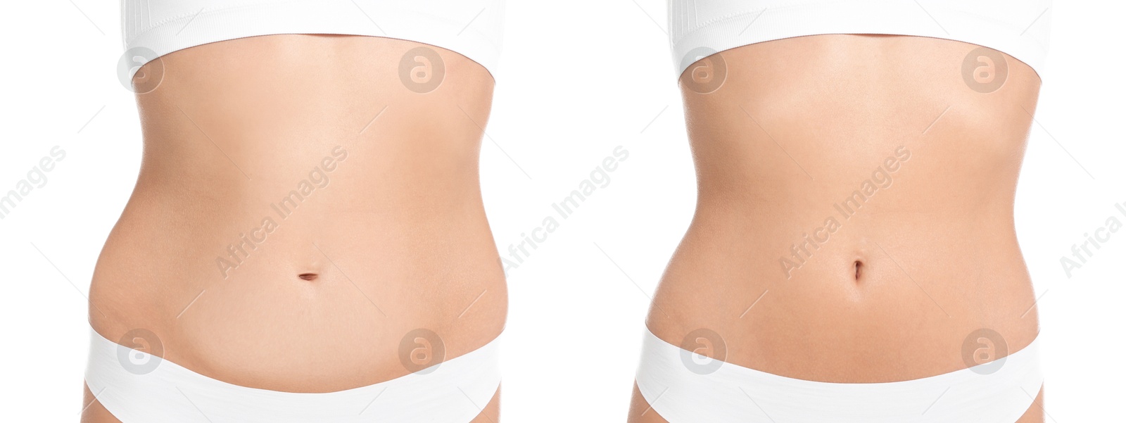 Image of Woman showing her belly with excess fat on one side and slim on other, closeup. Collage with photos before and after weight loss on white background