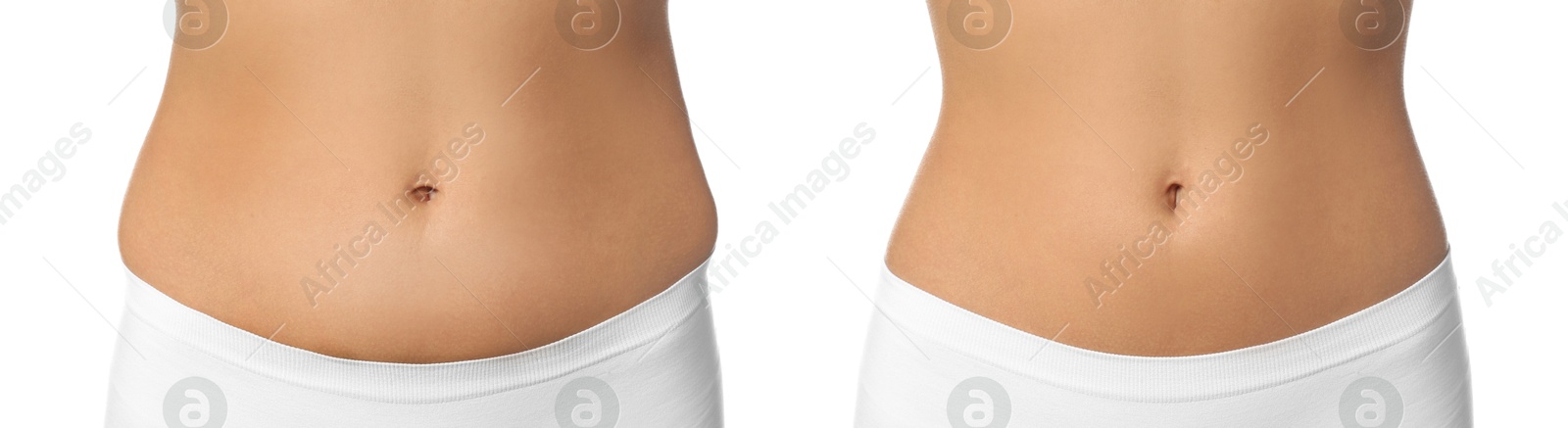 Image of Woman showing her belly with excess fat on one side and slim on other, closeup. Collage with photos before and after weight loss on white background