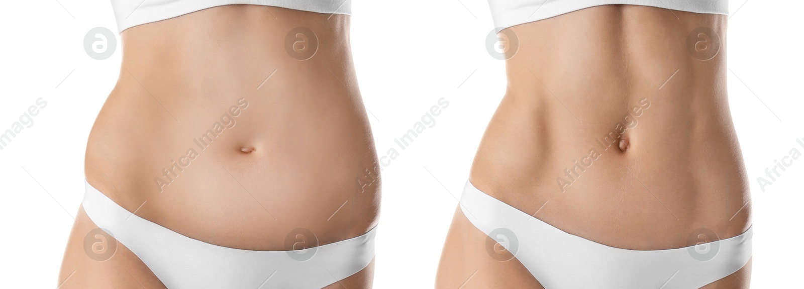 Image of Woman showing her belly with excess fat on one side and slim on other, closeup. Collage with photos before and after weight loss on white background