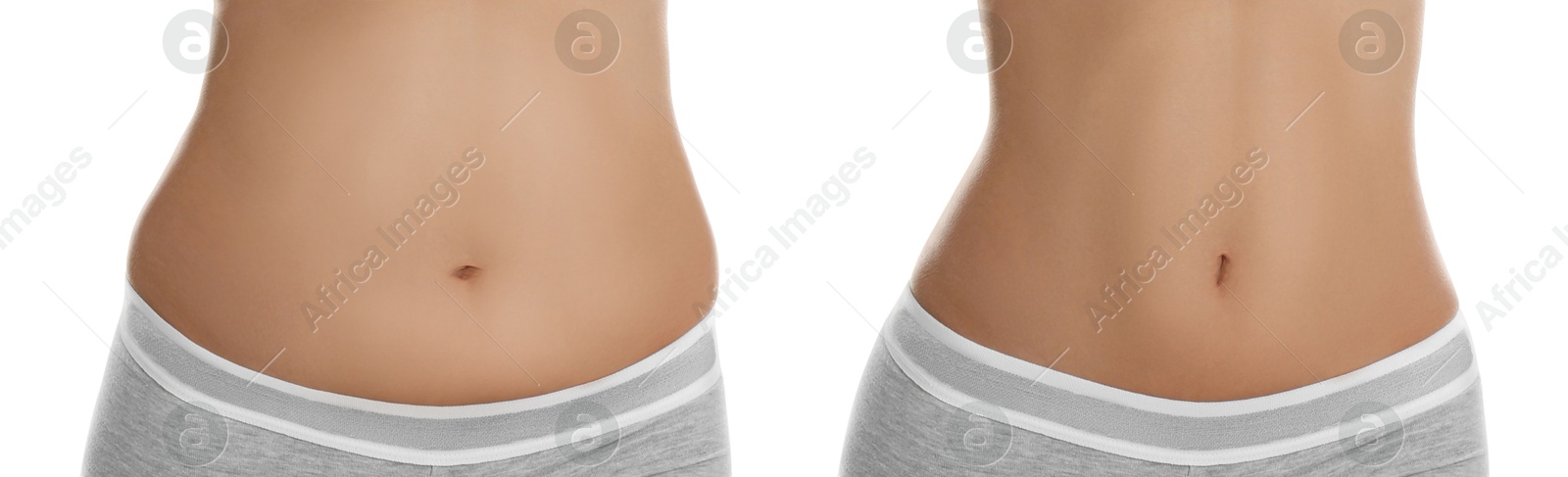 Image of Woman showing her belly with excess fat on one side and slim on other, closeup. Collage with photos before and after weight loss on white background