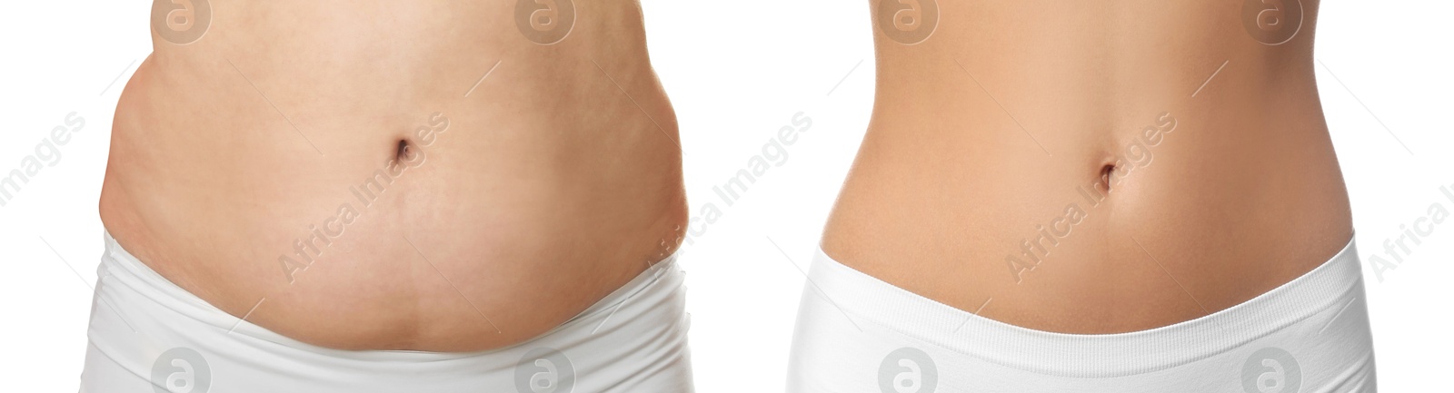 Image of Woman showing her belly with excess fat on one side and slim on other, closeup. Collage with photos before and after weight loss on white background